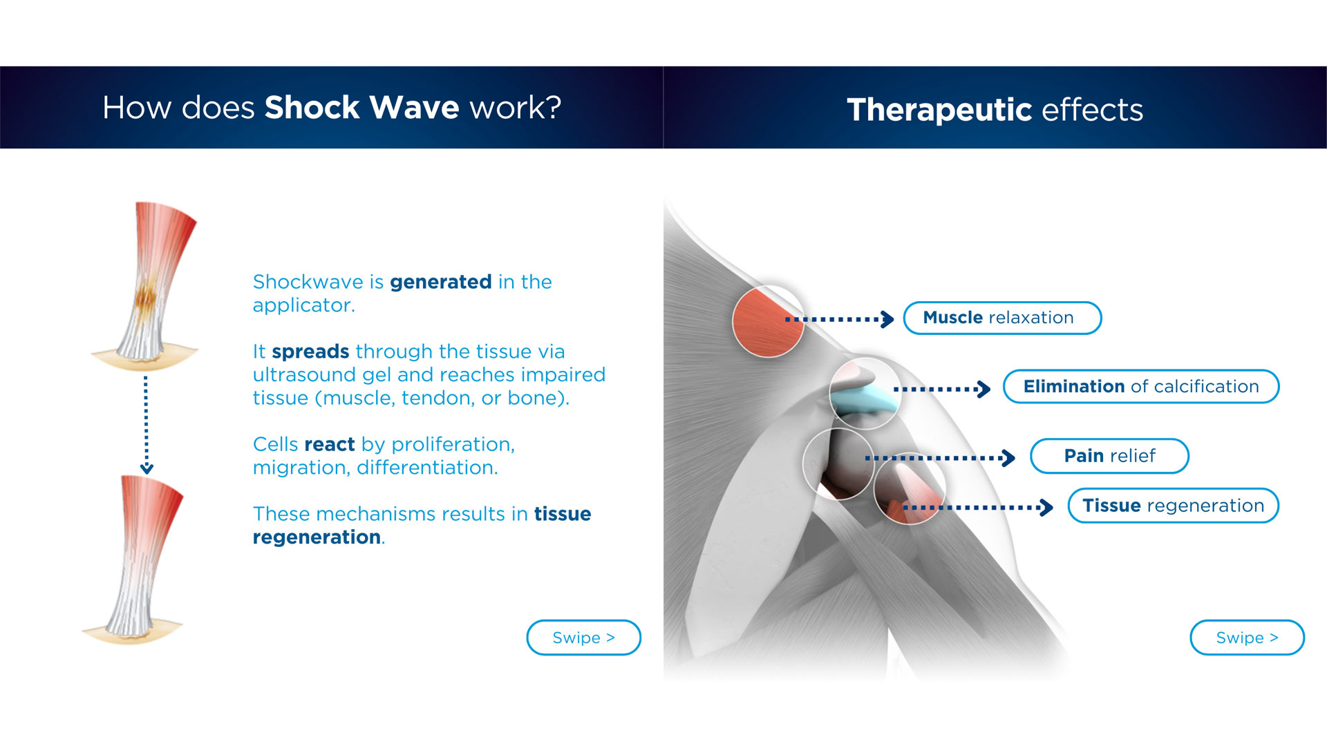 Fokussierte Stoßwellentherapie