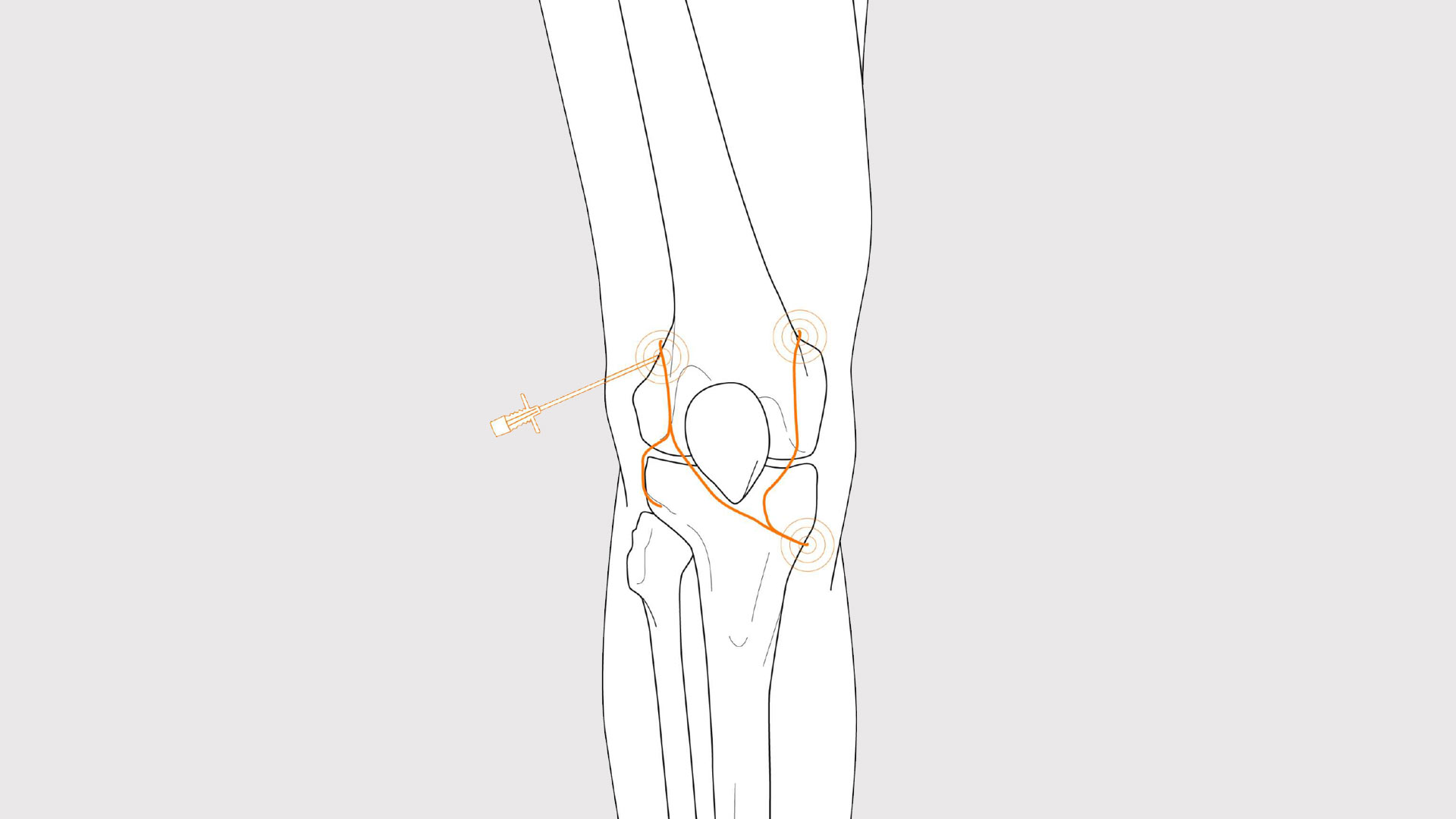 Radiofrequenzablationstherapie